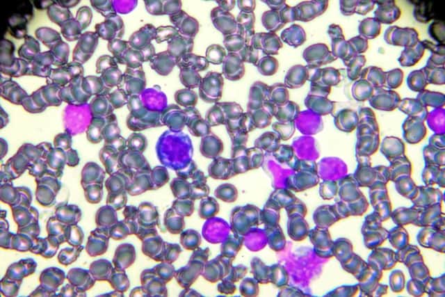 New treatment for children and adults with leukaemia (photo: Getty Images/iStockphoto)