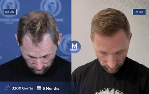 Photo supplied by MedArt Hair showing a patient who had 3,300 grafts and results after six months. Outcomes can vary and this is not necessarily representative of individual results.