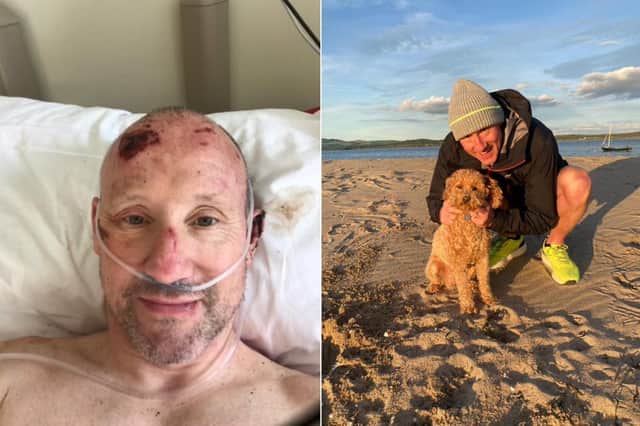 Mark Hanlon in hospital following the incident and pictured more recently at a beach.
