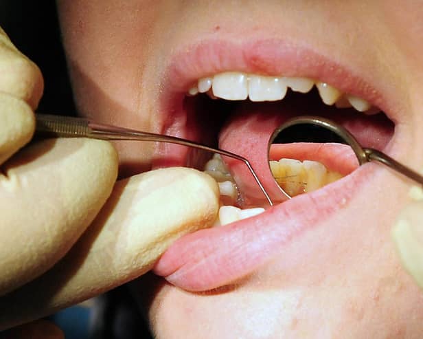 Tooth extractions on children in Northumberland have increased. Picture: PA Radar