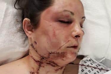 A picture released by Northumbria Police of Louise Pearce's injuries.