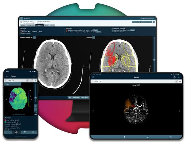 Brainomix’s e-Stroke software is being used to help stroke patients.