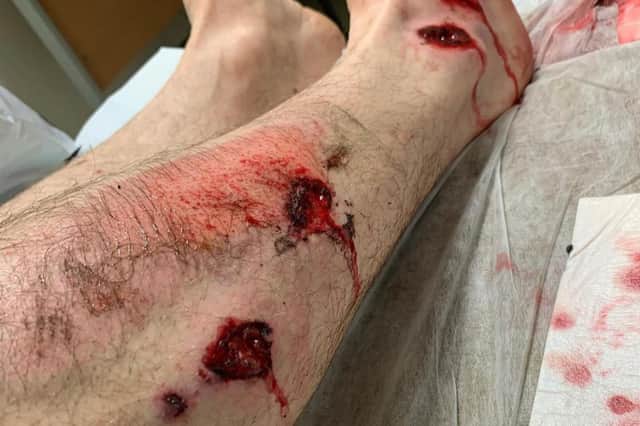 The injuries sustained by Sergeant Stephen Carr after he was hit by a car and dragged 30m on the road.