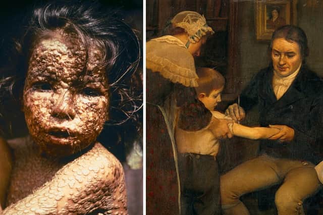 A child with smallpox, by James Hicks, Centers for Disease Control, and Dr Jenner vaccinating James Phipps, by Ernest Board, Wellcome Images.