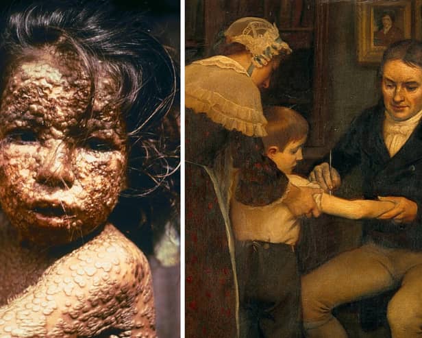 A child with smallpox, by James Hicks, Centers for Disease Control, and Dr Jenner vaccinating James Phipps, by Ernest Board, Wellcome Images.