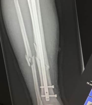 X-ray of Andrew Shell's repaired leg after it was broken during an Alnwick RFC rugby match.
