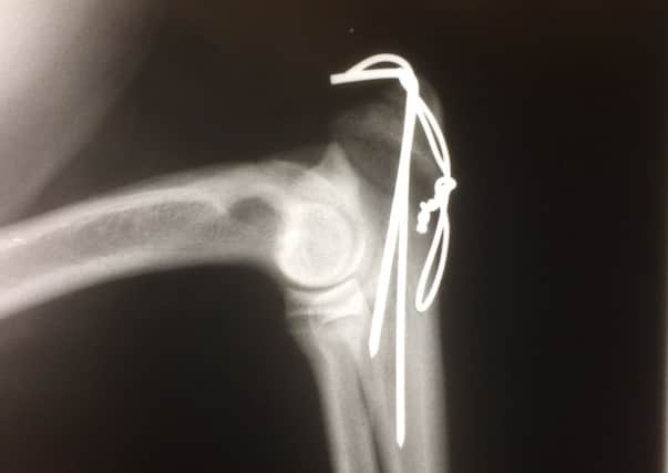 X-rays revealed that Mo's fracture did not extend into the joint itself.