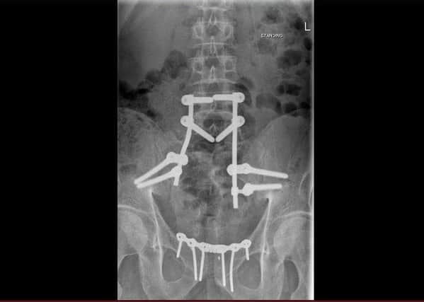 James Fernbacks x-ray of his spine and pelvis. He sustained a damaged spine and broken pelvis in the crash.