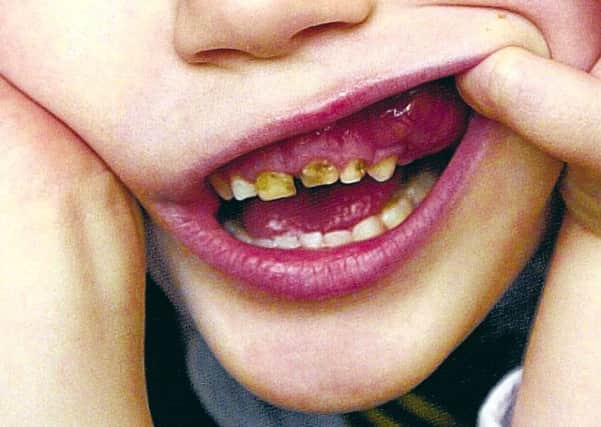Tooth decay in youngsters.