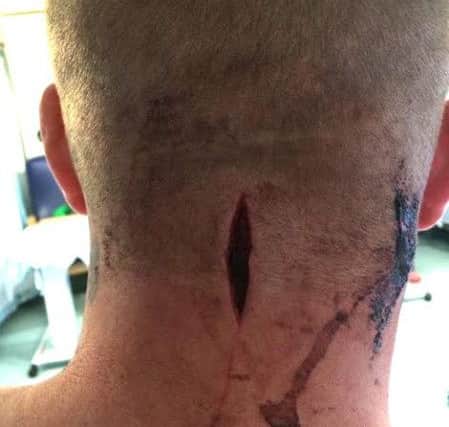 INS News Agency Ltd  13/11/2016This picture taken in his hospital bed shows one of the horrific stab wounds to the neck which soldier David Ferguson, 26, suffered in a multiple knife attack at his barracks in Aldershot, Hants., at 6am on Saturday morning.  Police have arrested two men on suspicion of attempted murder.